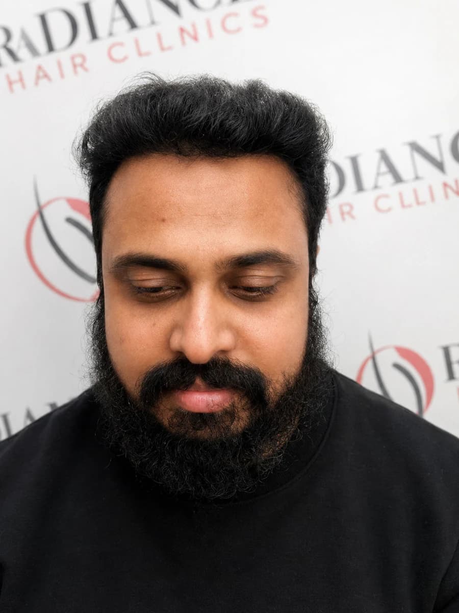 hair transplant case 002 front after