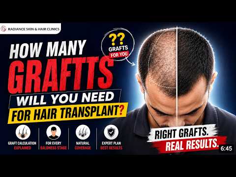 Hair Transplant Graft Planning: Video Guide by Radiance Clinics