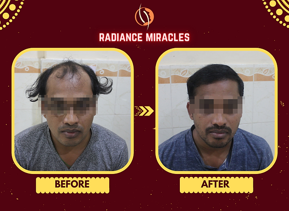 Best Hair Transplant in Cuttack | Radiance Skin & Hair Clinics