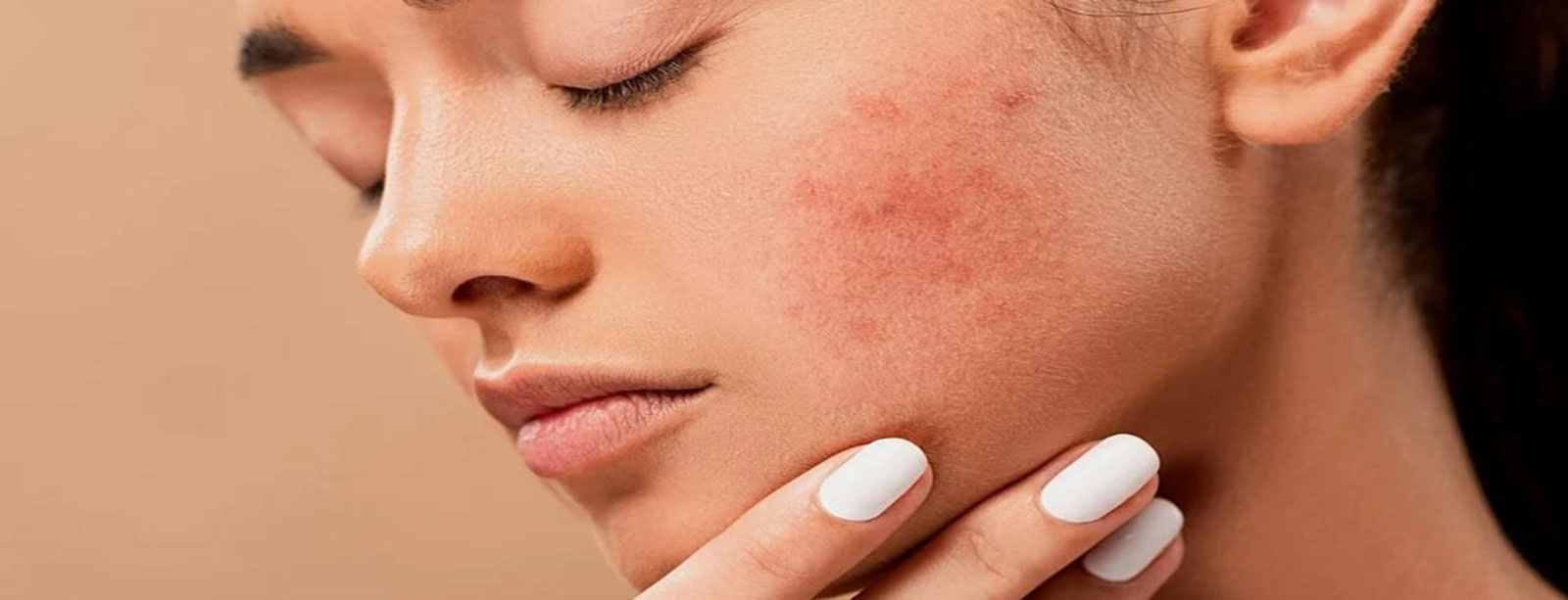 Acne Scars Treatment in Bhubaneswar