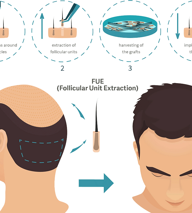 Hair Transplantation at Bhubaneswar | Radiance Clinics