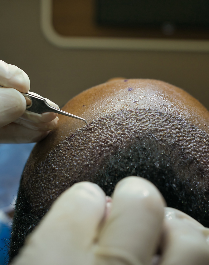 High Density Hair Transplant | Radiance Clinics