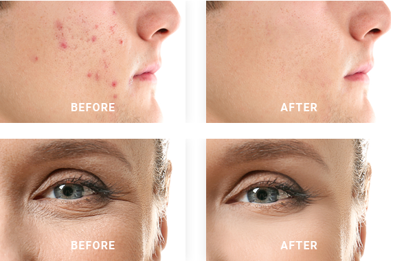 Acne Treatment in Bhubaneswar