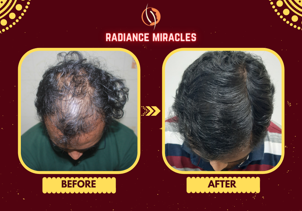 Best Hair Transplant in Balasore | Radiance Skin & Hair Clinics