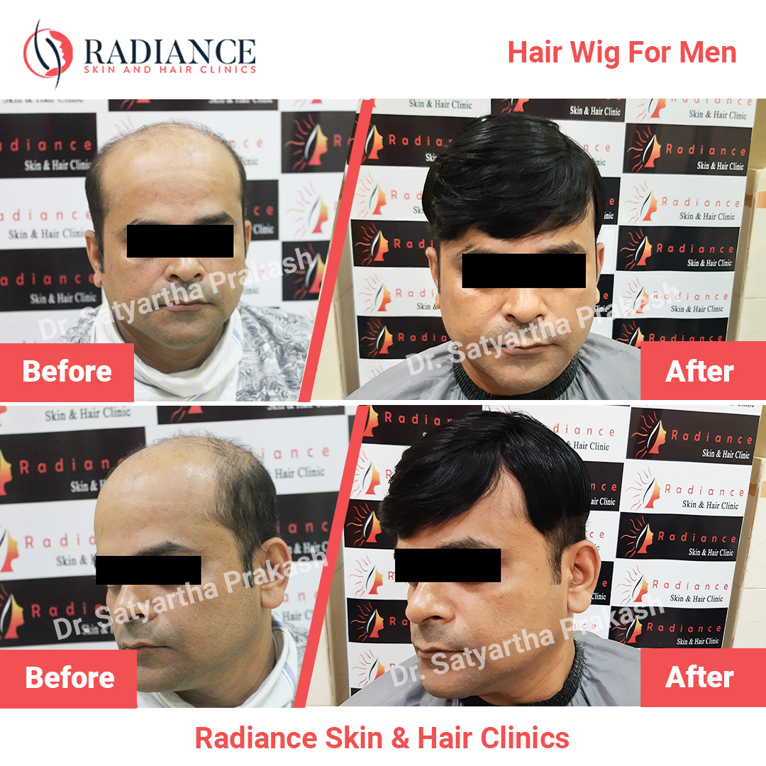 Hair Wig in Bhubaneswar | Radiance Skin & Hair Clinics