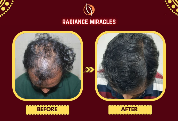 Hair Patch in Bhubaneswar | Radiance Skin & Hair Clinics