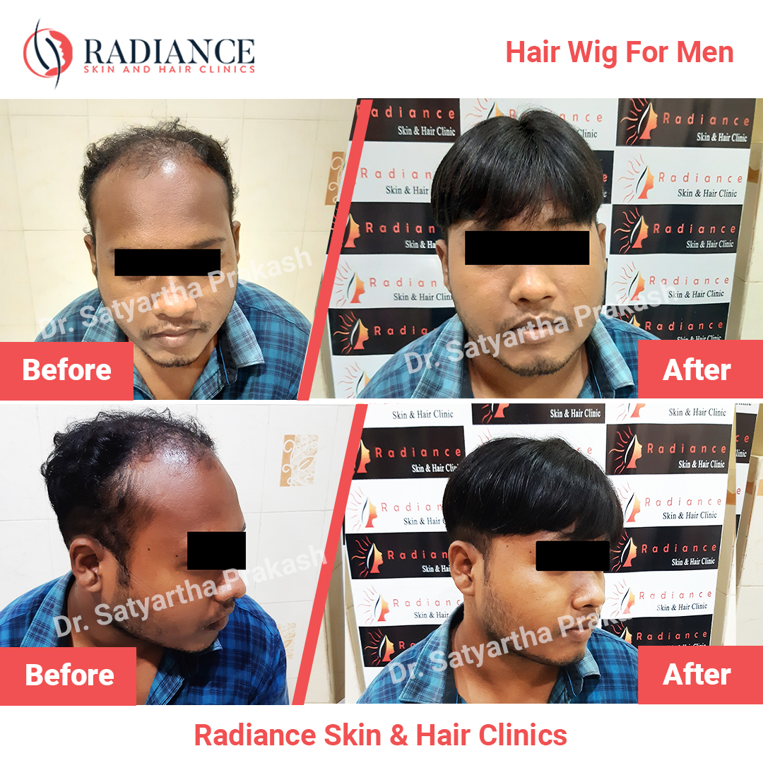 Hair Wig in Bhubaneswar | Radiance Skin & Hair Clinics