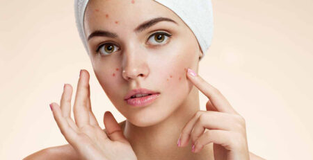 The Best Acne Scar Treatments to Boost Your Confidence