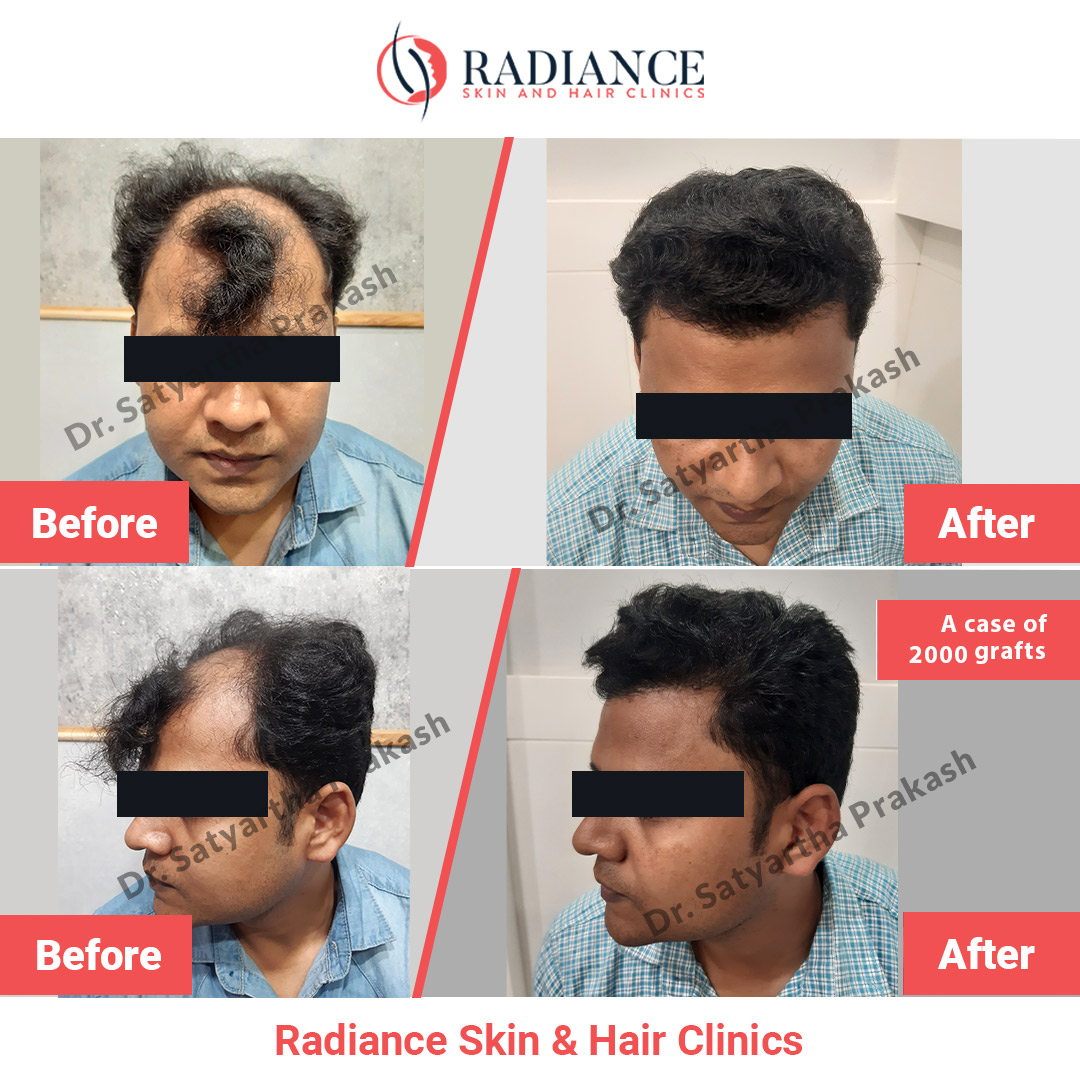 2000 Grafts Hair Transplant by Radiance Clinic