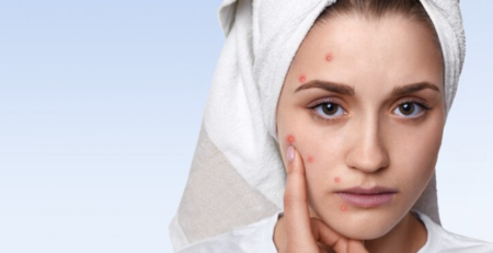 Best Solutions for Acne Scar Treatment