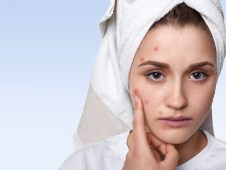 Best Solutions for Acne Scar Treatment