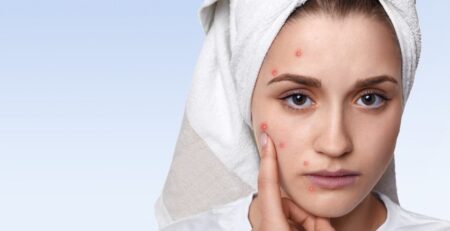 Acne scars