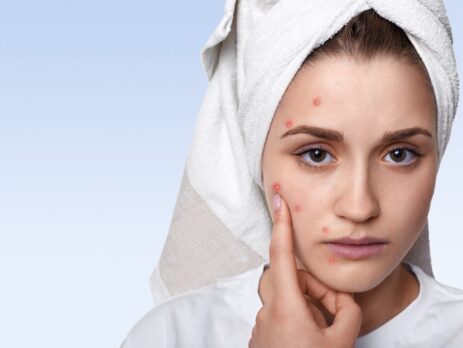 Acne scars