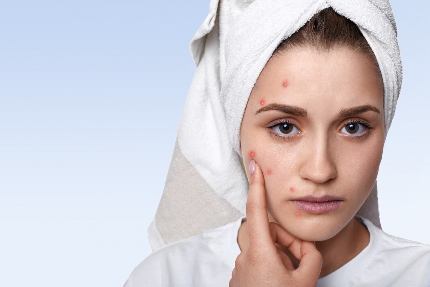 Acne scars