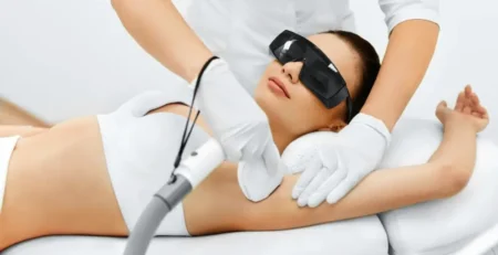 Laser hair removal