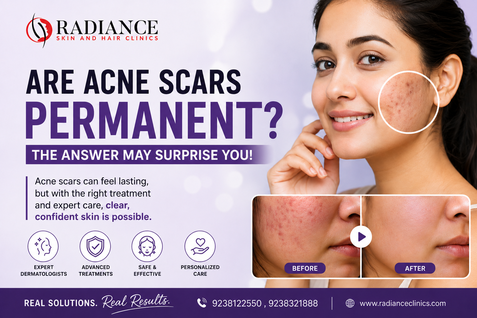 Acne scar solutions