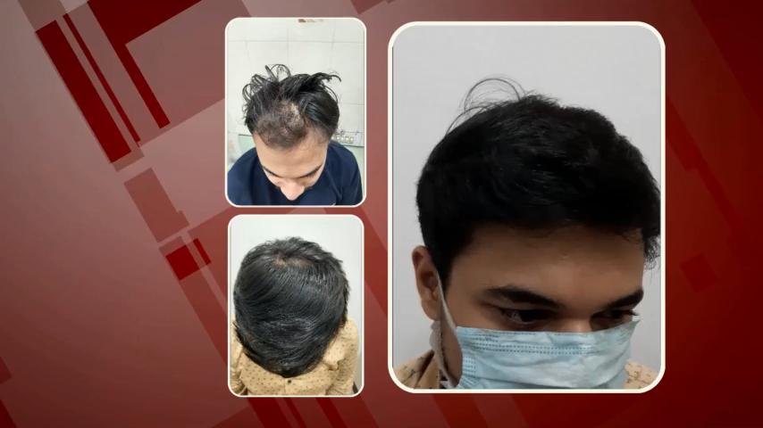Hair Transplant in Raipur